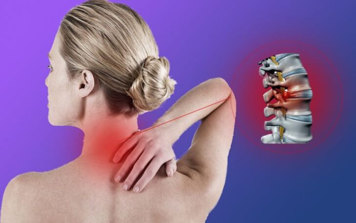 Osteochondroza kręgosłupa szyjnego prowadzi do rozwoju przepuklin międzykręgowych