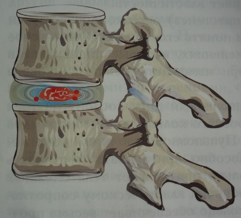 Uszkodzenie jądra miażdżystego krążka międzykręgowego w pierwszym stadium osteochondrozy szyjnej