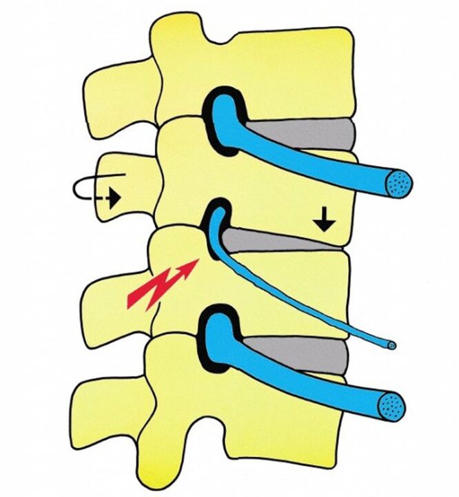 Zespół korzeniowy w osteochondrozie szyjnej jest bardzo powszechny