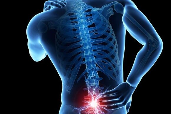 Ostry ból dolnej części pleców jest objawem przemieszczenia krążków międzykręgowych