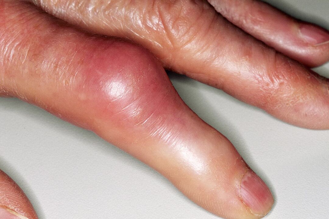 Obrzęk, deformacja stawu palca i ostry ból po urazie