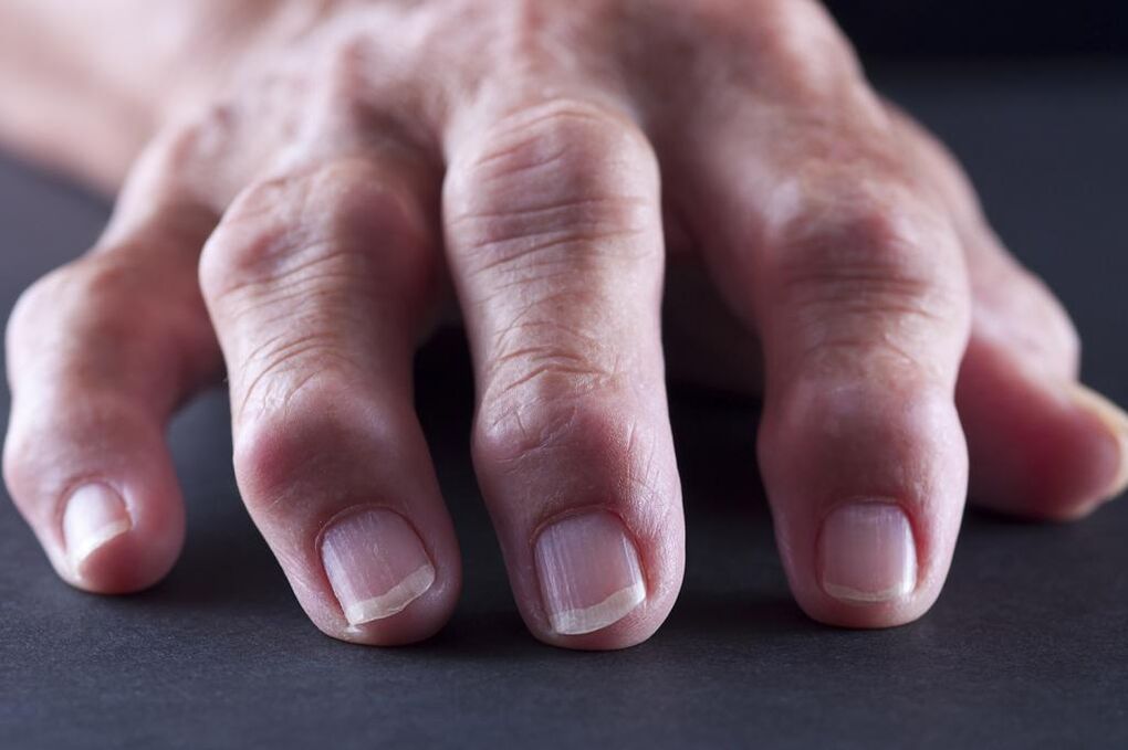 Zapalenie kaletki charakteryzuje się bólem, stanem zapalnym i obrzękiem stawów palców