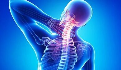 Objawy i leczenie osteochondrozy szyjki macicy