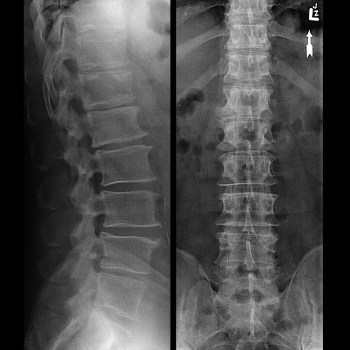 Snfing kręgosłupa z osteochondrozą
